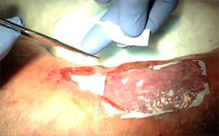 apply talymed to wound