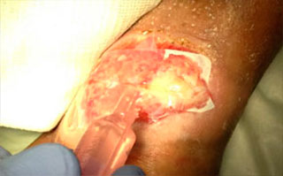 apply saline to wound