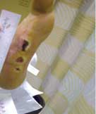 severe diabetic foot ulcer